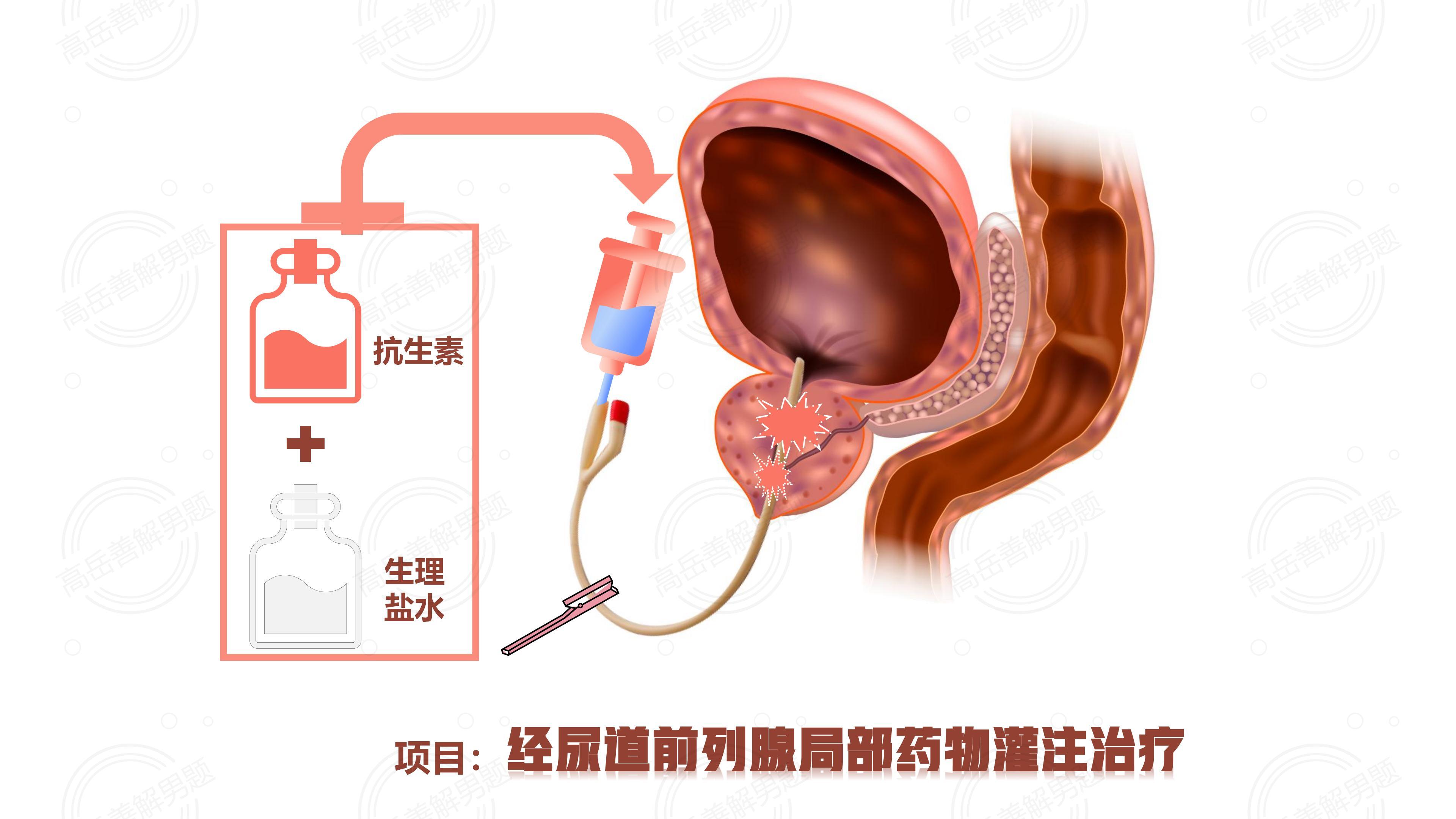 最新前列腺治療方法分享，小紅書上的治療新篇章?